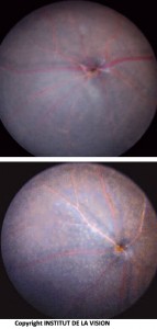 Fundus of the eye of knock-out and control mice. Sub-retinal macrophages (knockout mouse) are visible as small white dots.