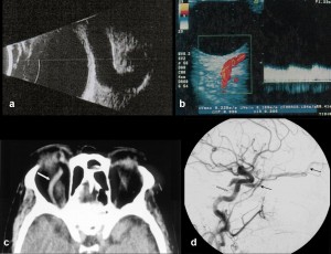 Ph 3 a) ecografia B-scan; b) eco-colordoppler; c) TC orbite; d) angiografia cerebrale (fase arteriosa): FCC durale a partenza dalle branche meningee dell’art. faringea ascendente (freccia bianca). Dilatazione della vena oftalmica superiore (frecce nere).