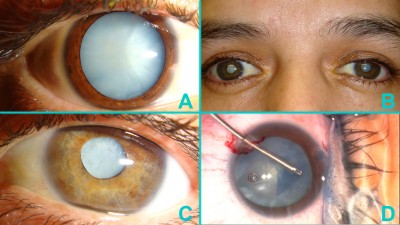 Fig. 2: Cataratte bianche soffici e lattiginose. Queste cataratte sono piene di liquido e pongono ulteriori difficoltà sul piano chirurgico. Un aspetto omogeneo, lattiginoso dell’intero cristallino (A) è più comune nei pazienti giovani (B), che spesso presentano delle cataratte bilaterali. La mancanza delle tonalità gialle o marroni è indicativa di una minore sclerosi nucleare (C). Mantenere la camera anteriore pressurizzata e utilizzare delle micro-pinze (D) è utile a ridurre al minimo le complicanze mentre viene realizzata la capsuloressi.