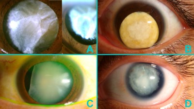 Fig. 3: Cataratte bianche anomale. Il contorno irregolare della capsula anteriore (A) fa presumere una contrazione della capsula, una fragilità zonulare e susseguenti difficoltà. Questa cataratta traumatica è prolassata in camera anteriore (B) una volta che la pupilla è stata dilatata. Ad un esame approfondito il paziente (C) è risultato avere un ampio settore di mancanza congenita della zonula. Talvolta le cataratte bianche possono essere associate ad altre comorbilità come in questo caso di aniridia (D).