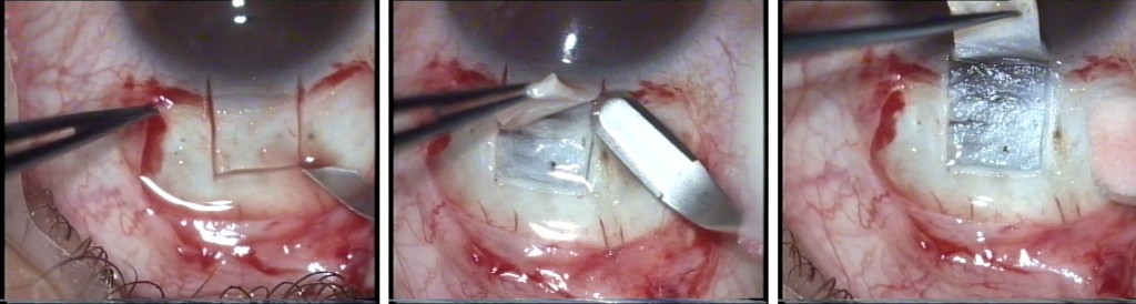 Fig. 2 a-b-c: Facotrabeculectomia a due vie. Preparazione dello sportello sclerale ad ore 12 (a-b); la dissezione sclerale viene portata in piena cornea (c). 