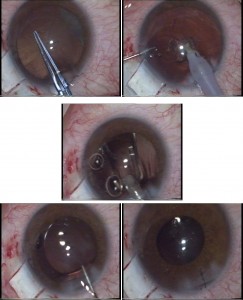 Fig. 4 a-b: Asportazione di un tassello di tessuto sclerale sotto lo sportello con bisturi e forbice. Incisione con bisturi (a); tassello sclero-corneale asportato (b) – Fig. 5: Esecuzione di iridectomia periferica con pupilla in miosi. - Figura 6 a-b: Sutura dello sportello sclerale(a); applicazione di due punti di sutura (b). – Fig. 7: Sutura della congiuntiva con due punti.