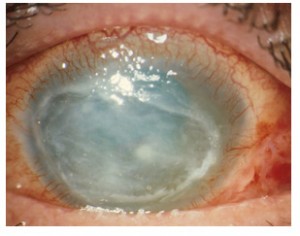 Ph. 1: Occhio affetto da Cheratite da Acanthamoeba