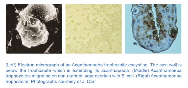 Ph. 2: Il protozoo Acanthamoeba spp nello stadio di trofozoite
