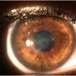 Cheratite da Acanthamoeba e terapia medica
