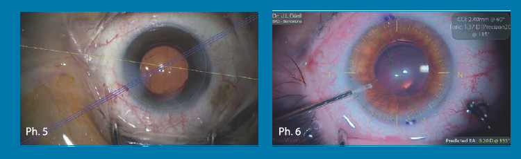 Fig. 5. Il sistema Callysto di Zeiss. Fig. 6. Il sistema TrueGuide di TrueVision.