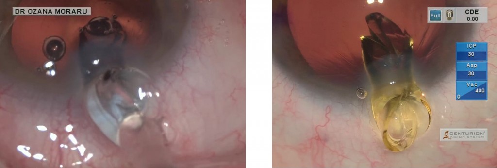 Figg. 1-2. Due diverse IOL toriche bloccate in un’incisione da 1,8 mm, il che determina un allargamento traumatico dell’incisione, con un SIA accresciuto e incontrollabile e una possibile mancanza di self healing (guarigione spontanea) a fine procedura, con conseguente necessità di sutura.