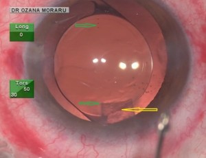 Ph. 3: A femto-cataract procedure, where , despite the perfect incision done by the FemtoLaser (yellow arrow), its lack of transparency impair a bit the toric IOL markings in that zone (green arrows).