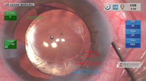 Ph. 4: Eye with previous Radial Keratotomies: the superior toric markings (red arrow) are difficult to be seen, in comparison with the inferior ones, because of the main incision, situated in the same place (blue arrow); RKs and anterior capsule epithelial cells increase the difficulty of the IOL markings visualization.