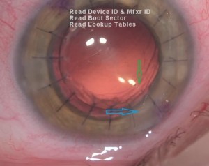 Ph. 5: Eye with previous Penetrating Keratoplasty, where the main incision (blue arrow) has been correctly planned and done a bit apart from the IOL toric marking (green arrow) – thus, the marking is easily visible.