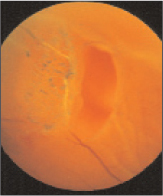 Fig. 6. Rottura retinica causata da Distacco Posteriore del Vitreo.
