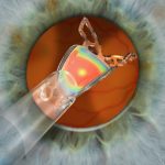 Live surgeries with Mini WELL and Mini TORIC (SIFI)