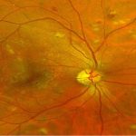 Il Farmacista e le complicanze oculari del diabete