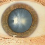 cataract