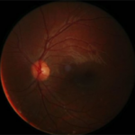 Leber's optic neuropathy