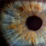 moraxella keratitis