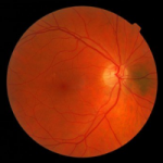 macular hole surgery