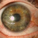 corneal ulcer