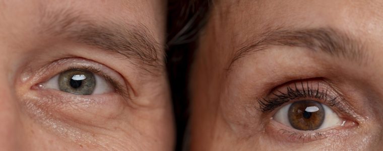 Occhio secco: il ruolo degli ormoni