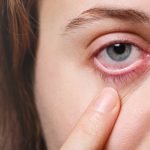 iritis causes symptoms diagnosis