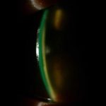 Stevens Johnson syndrome and the eye