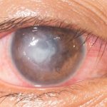 Cogan's syndrome: rare but treatable