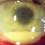 Endophthalmitis: decreasing rates