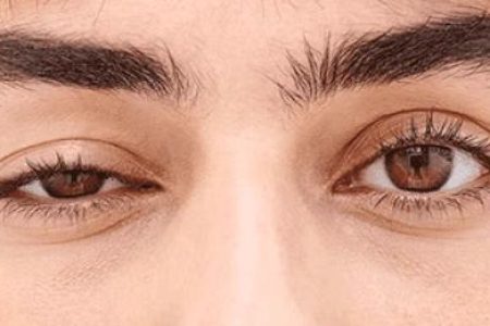 Miastenia gravis: oculisti in prima linea