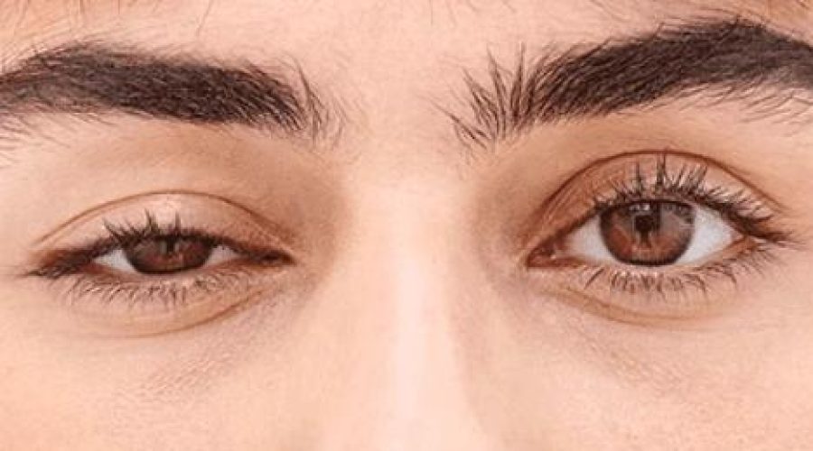 Miastenia gravis: oculisti in prima linea