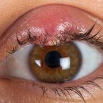 Stye: causes and prevention
