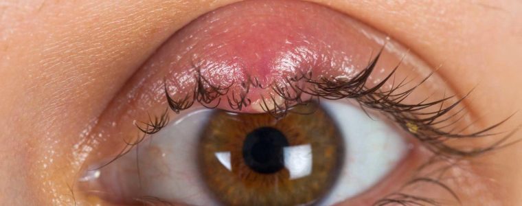 Orzaiolo: cause e prevenzione