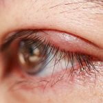 Chalazion: causes and remedies