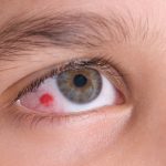 Rupture of the Ocular Capillaries