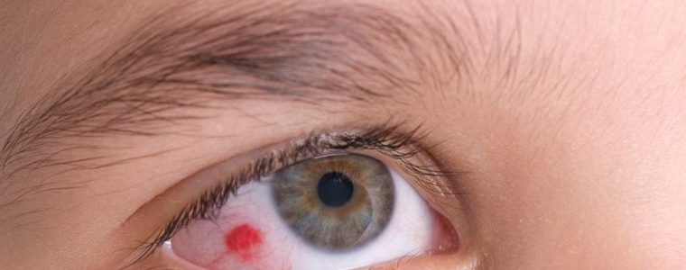Rottura dei Capillari Oculari