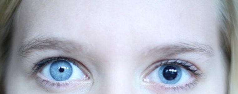Anisocoria: What is it and why does it occur?