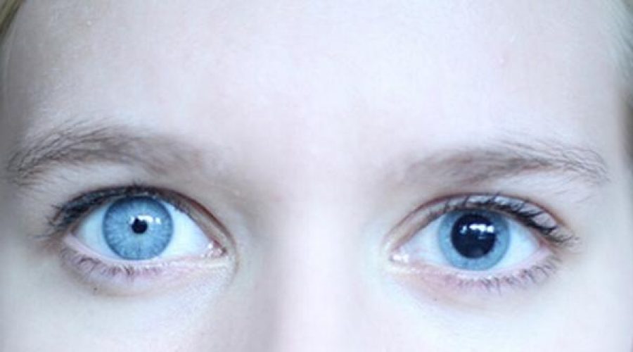 Anisocoria: Cos’è e perché si verifica?