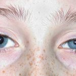 Horner's syndrome in children and apraclonidine