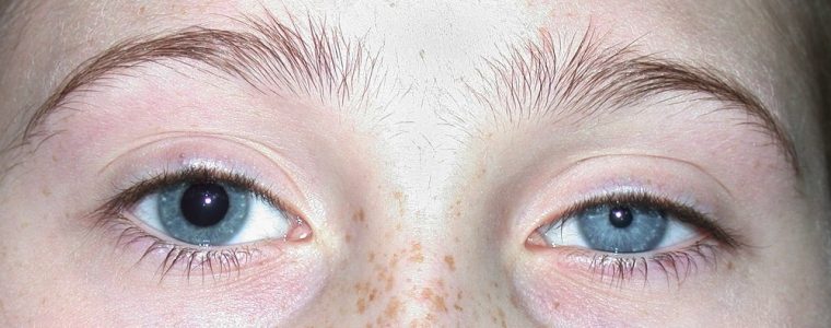 Horner's syndrome in children and apraclonidine